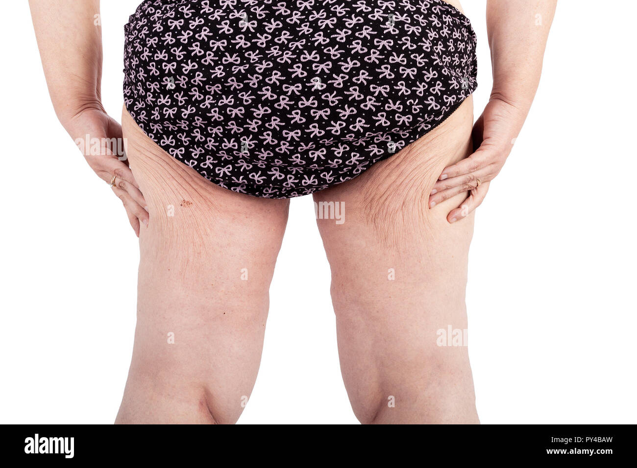 Middle aged woman with saggy skin after extreme weight loss Stock Photo