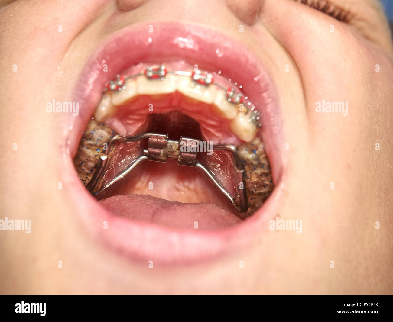 Mouth with retainer Braces for Teeth. Orthodontics Dental Theme Methods