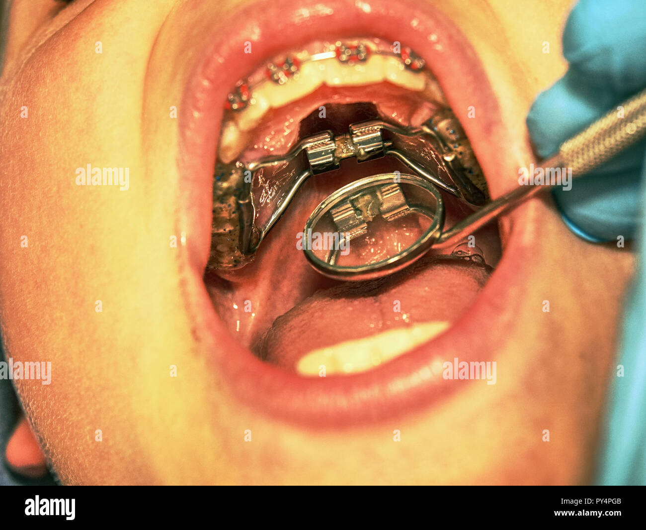 Dental braces in a young boy mouth. Teen with braces on his teeth