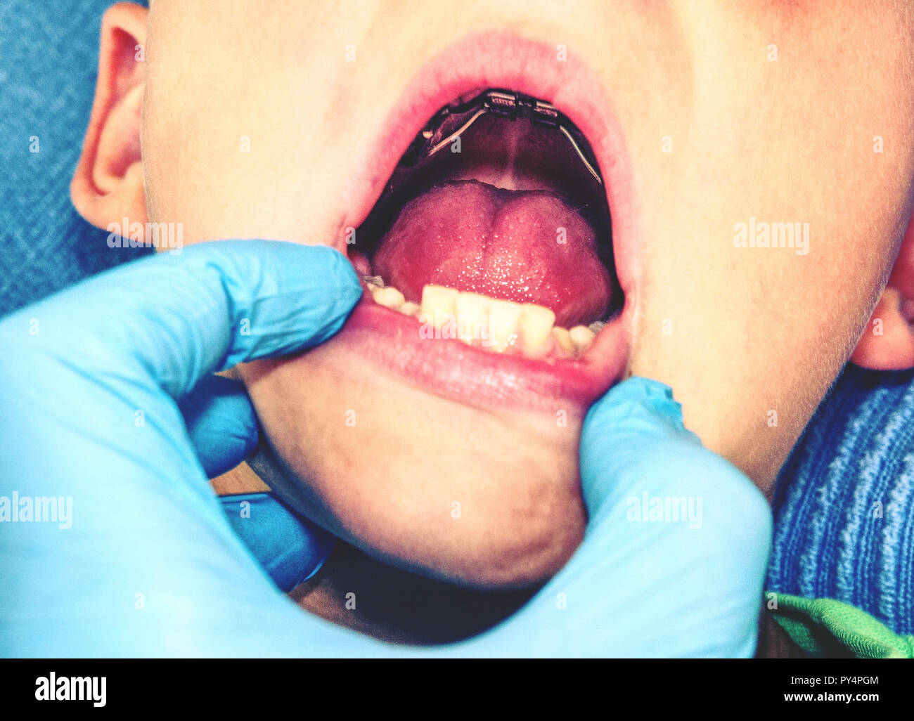 Dental braces in a young boy mouth. Teen with braces on his teeth