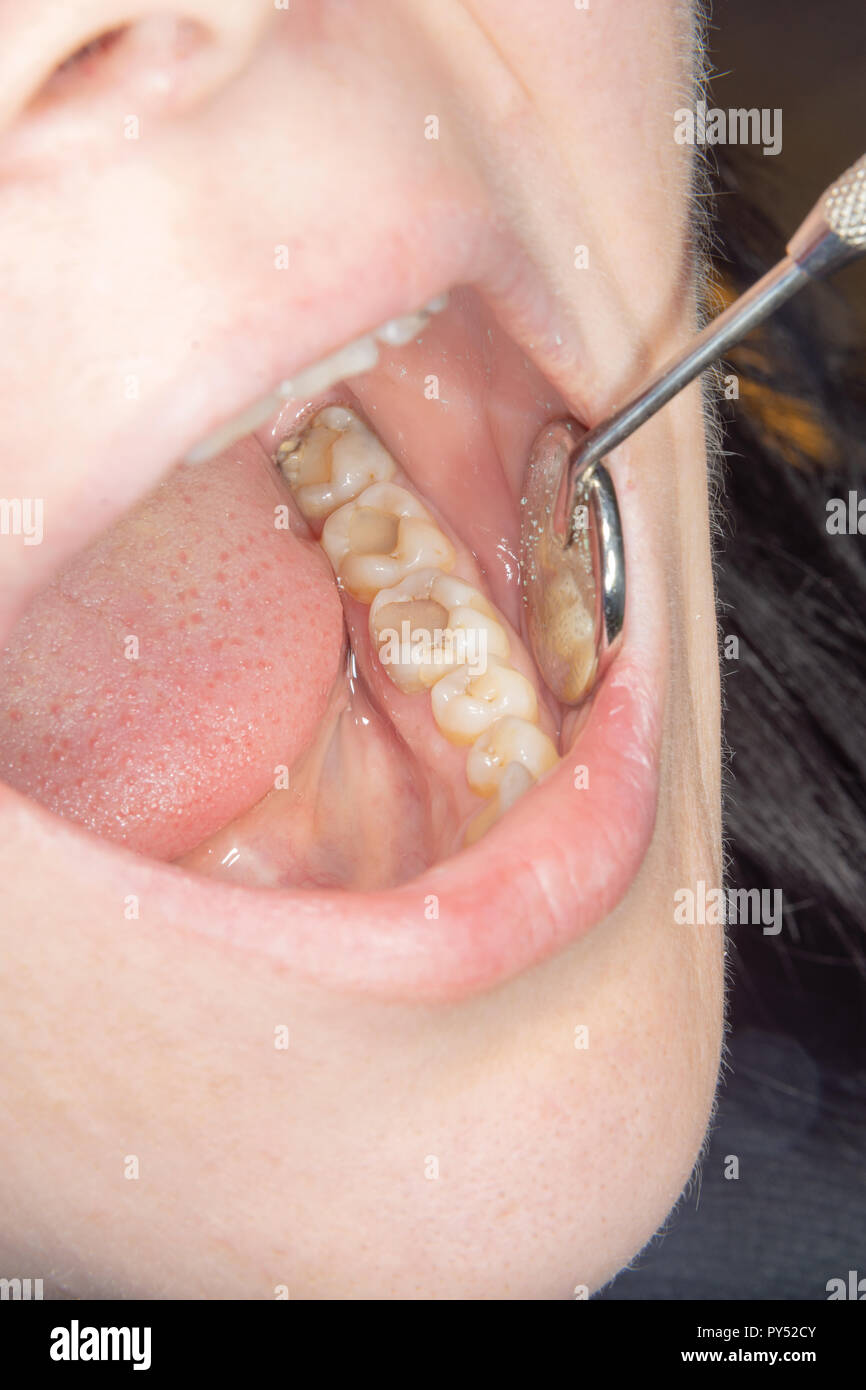 two chewing side teeth of the upper jaw after treatment of caries