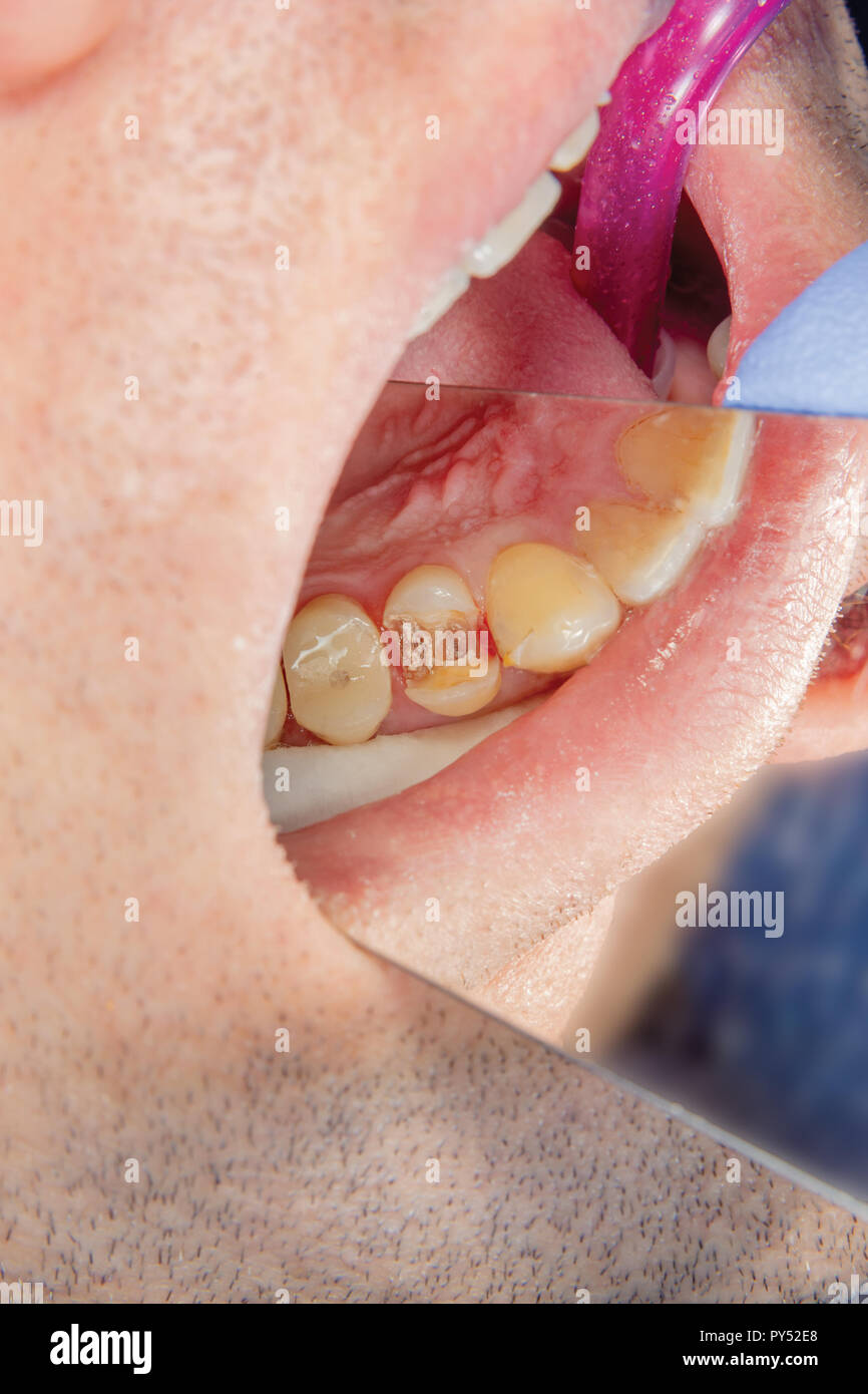 Dental Caries Filling With Dental Composite Photopolymer Material