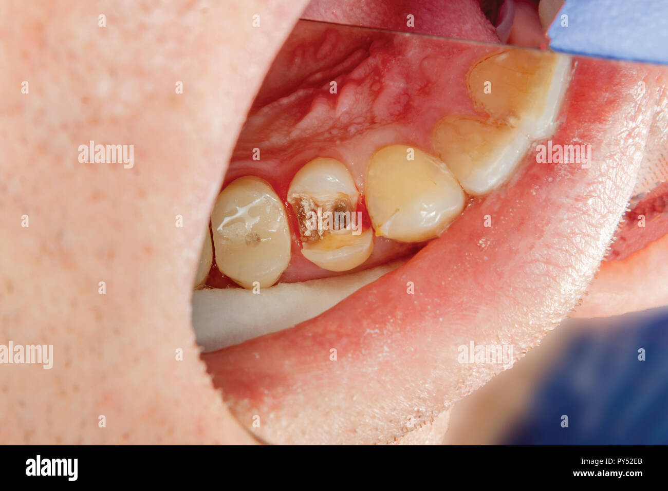 two chewing side teeth of the upper jaw after treatment of caries