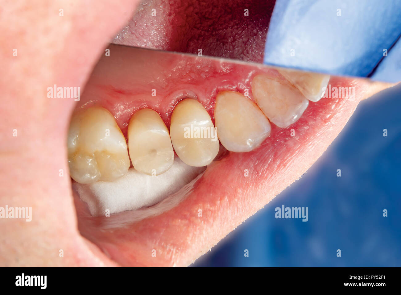 two chewing side teeth of the upper jaw after treatment of caries