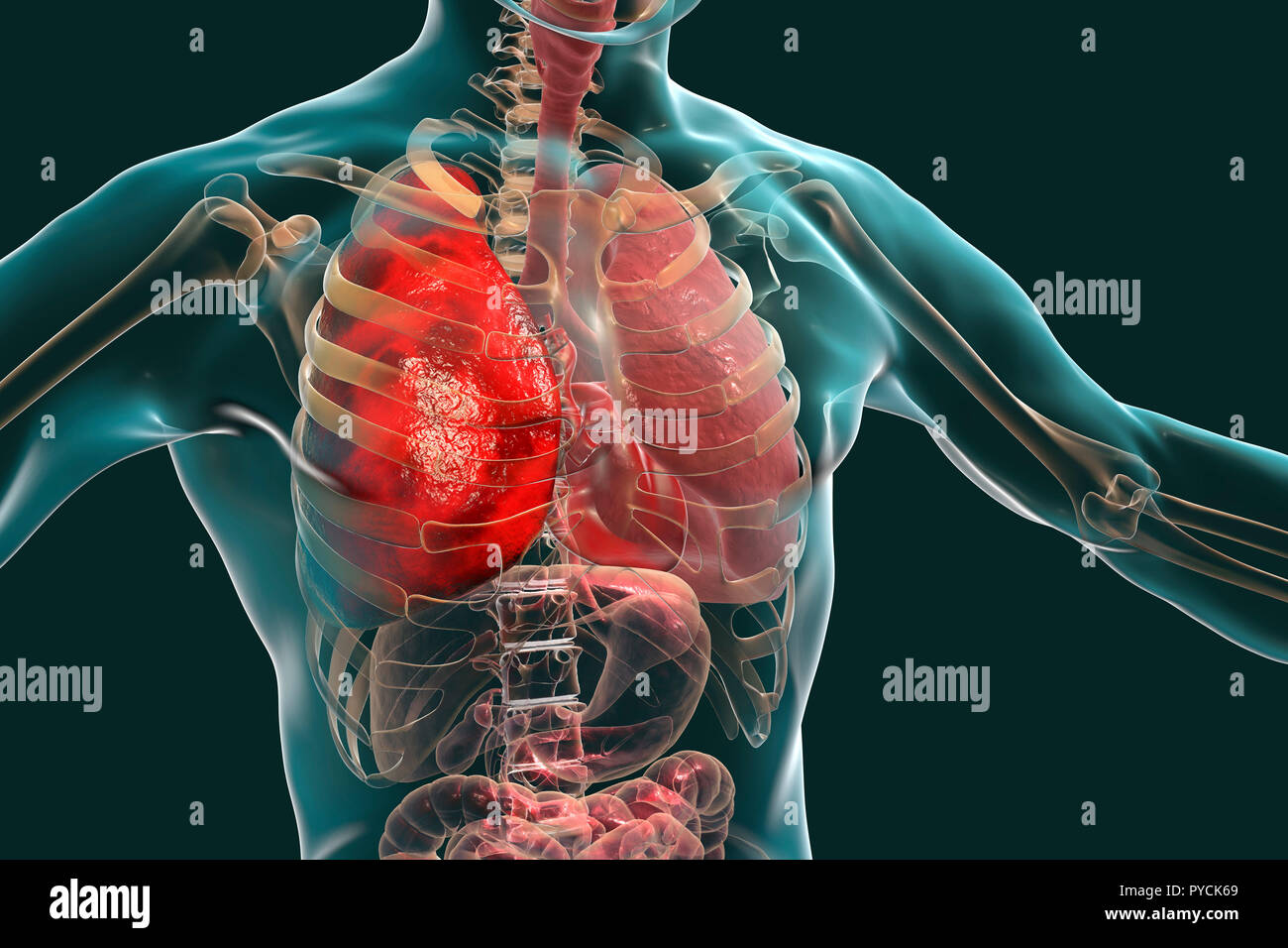 Pneumonia, illustration. Pneumonia is an inflammatory condition of the lung. Stock Photo