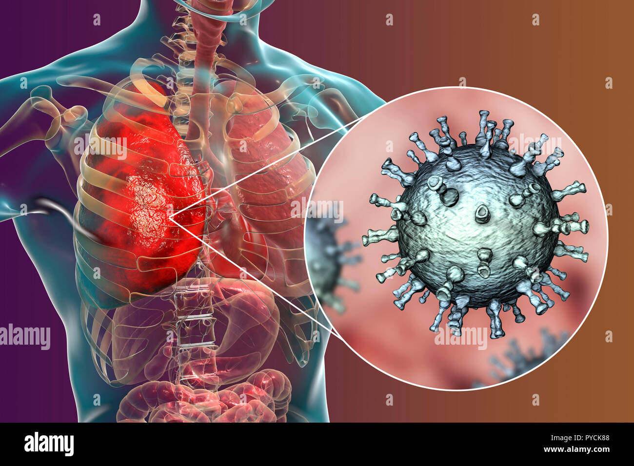 Pneumonia caused by varicella zoster virus (VZV), computer illustration. VZV is a virus from the Herpesviridae family, the causative agent of chickenpox and shingles. In severe cases VZV may cause complications, such as pneumonia and encephalitis. Stock Photo