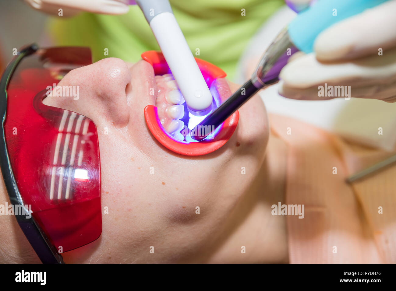 Tooth filling ultraviolet lamp.Girl patient in the dental clinic. Teeth whitening UV lamp with