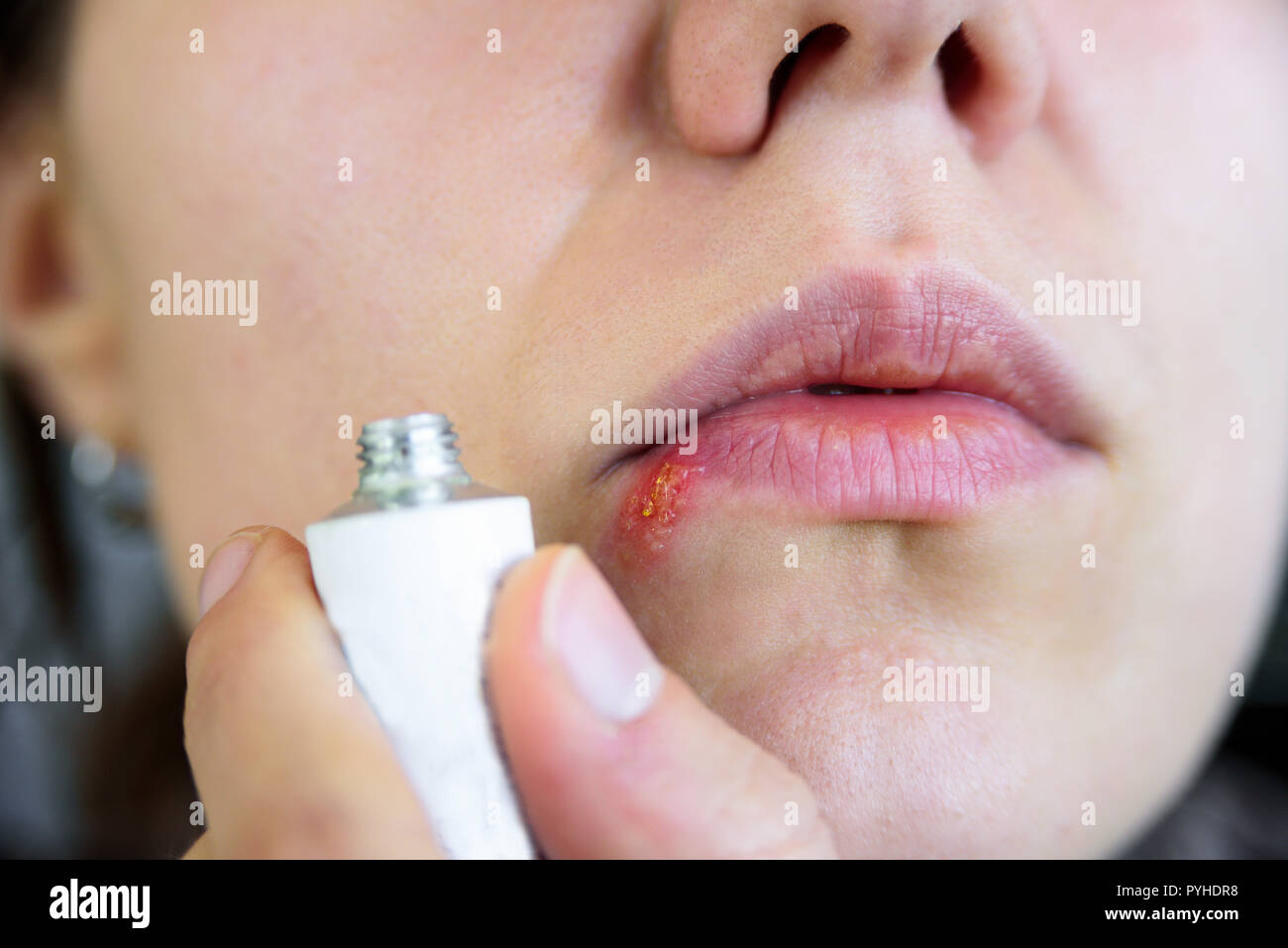 Herpes on young woman lips and cream in her hands. Close up Stock Photo