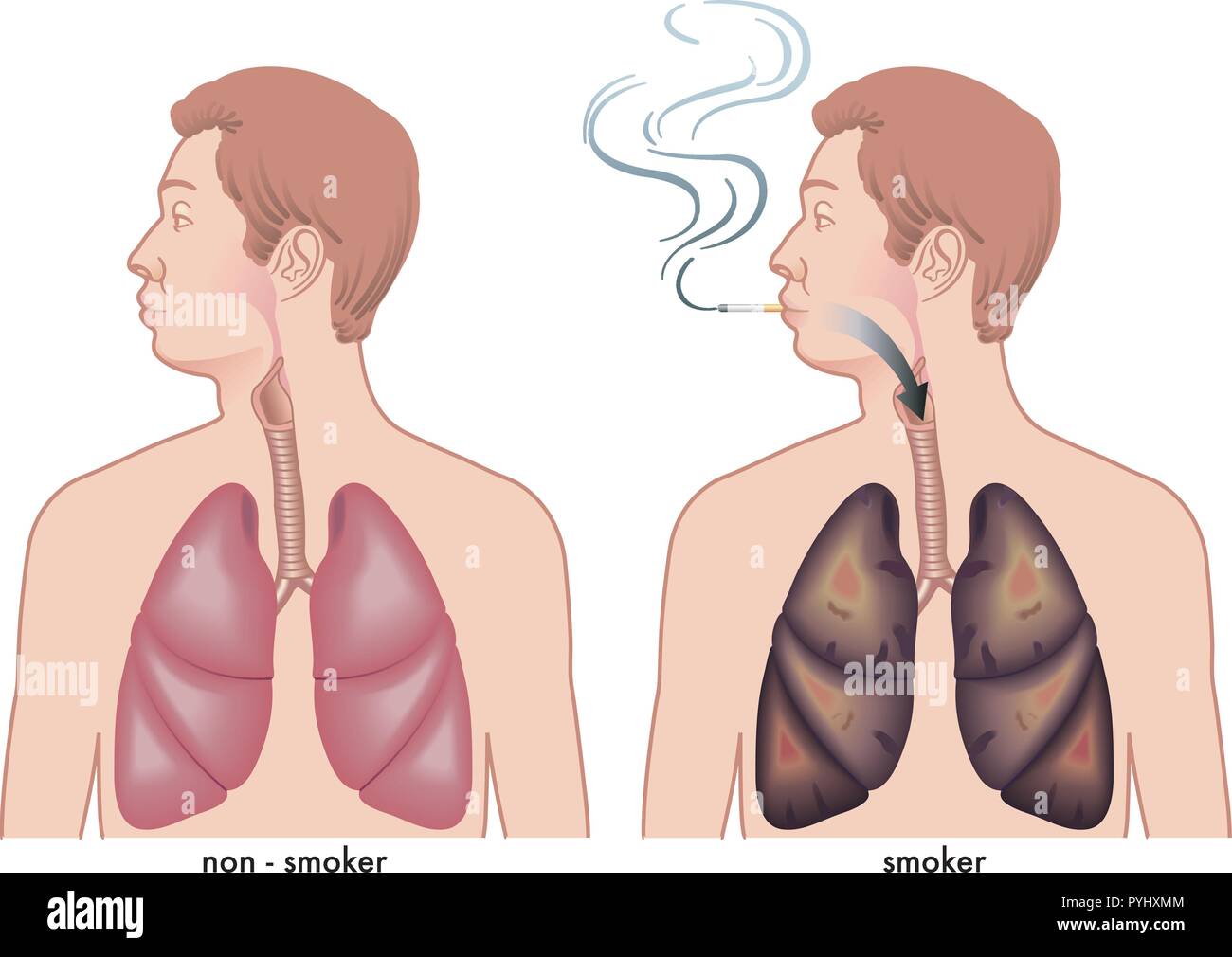 medical illustration of the effects of cigarette smoking on the lungs Stock Vector