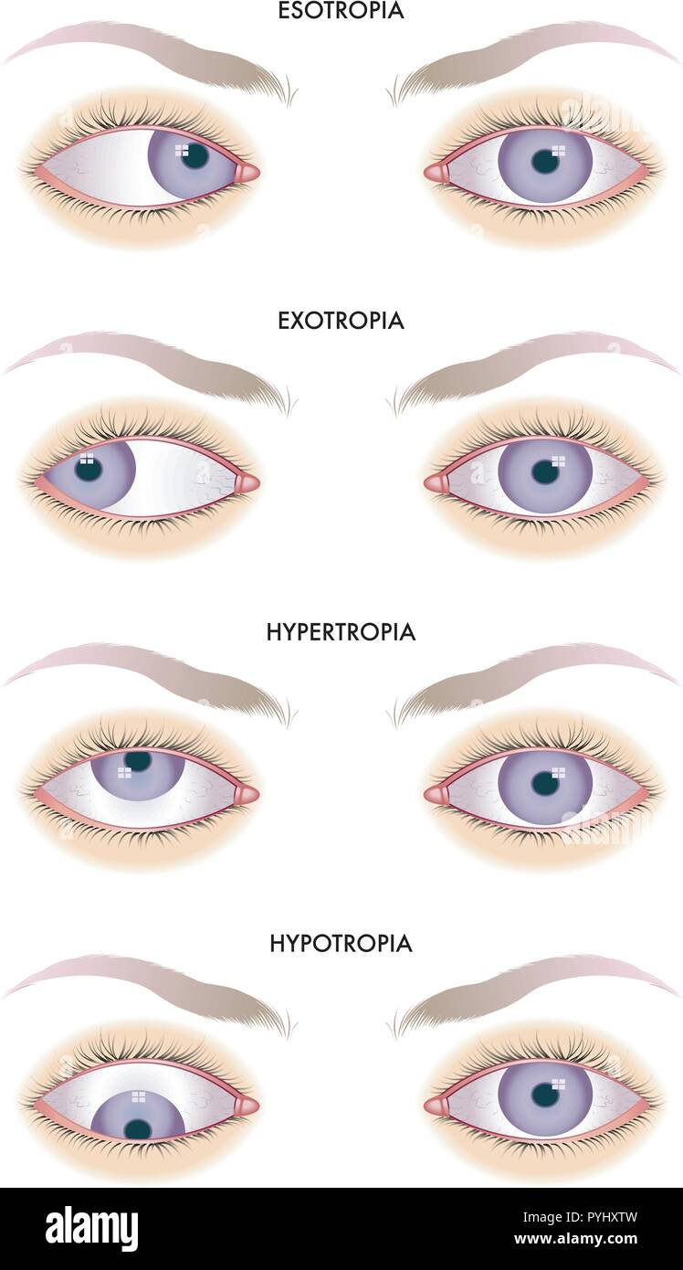 medical illustration of the effects of the strabismus Stock Vector