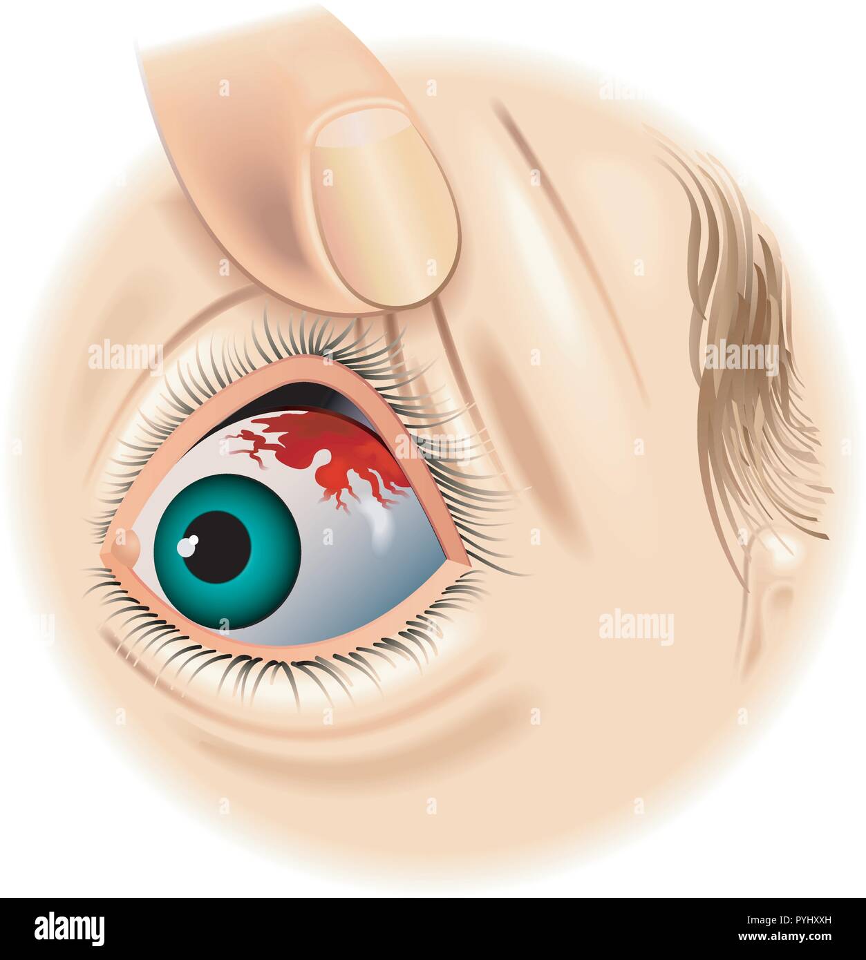 medical illustration of the symptoms of subconjunctival hemorrhage Stock Vector