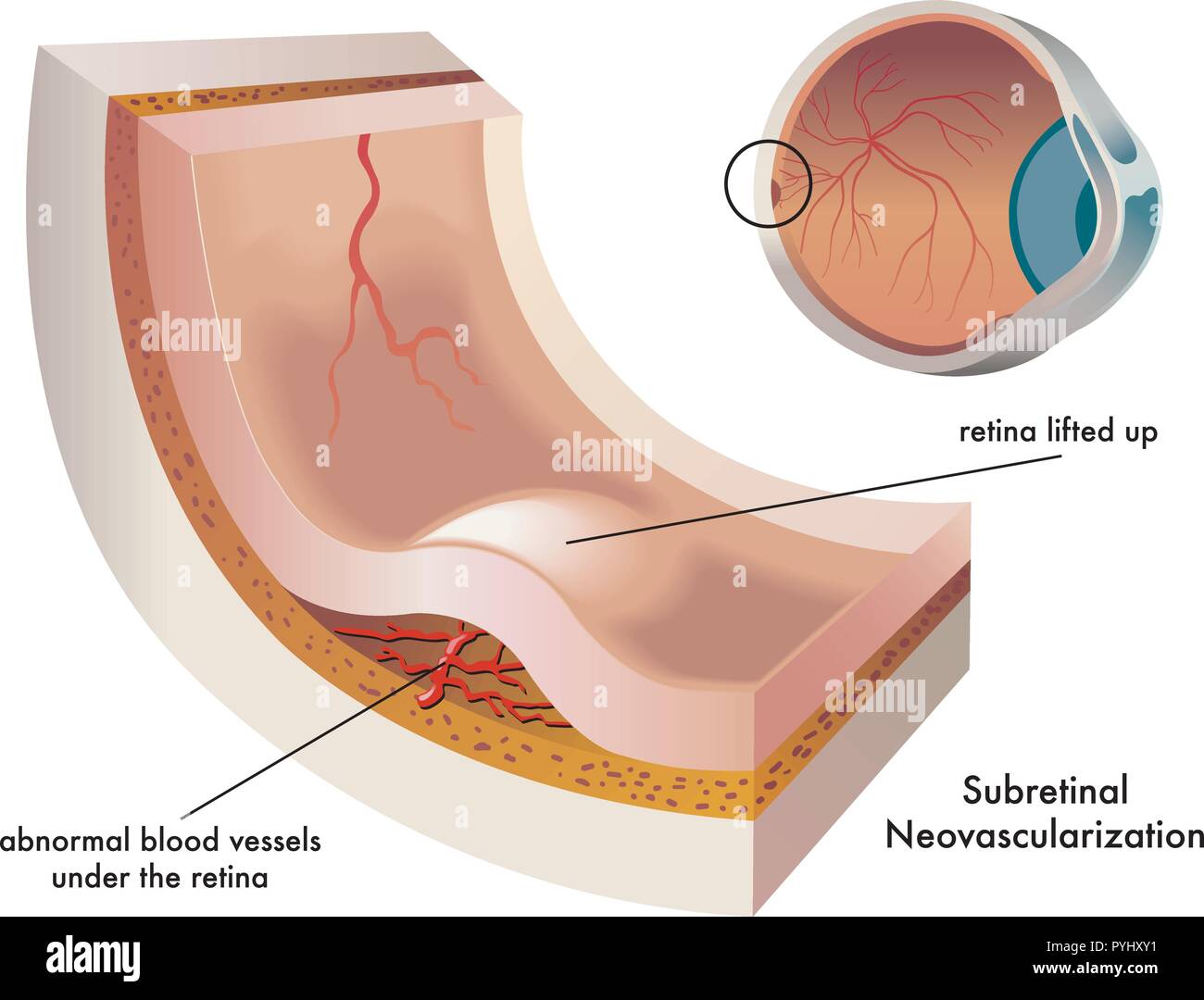 medical Illustration of the formation of a subretinal neovascularization of the eye Stock Vector