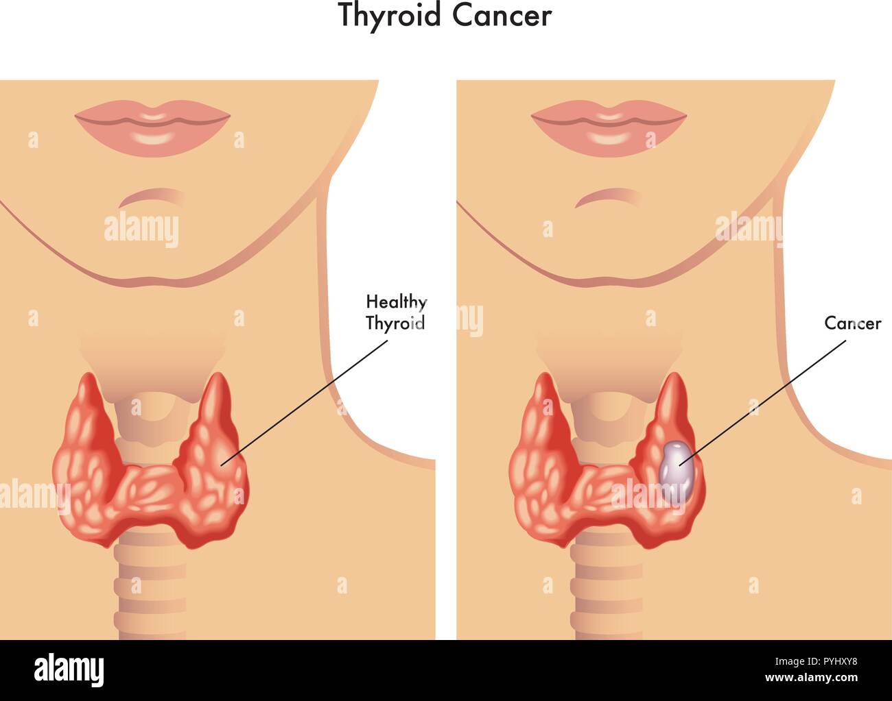 medical illustration of the effects of the thyroid cancer Stock Vector
