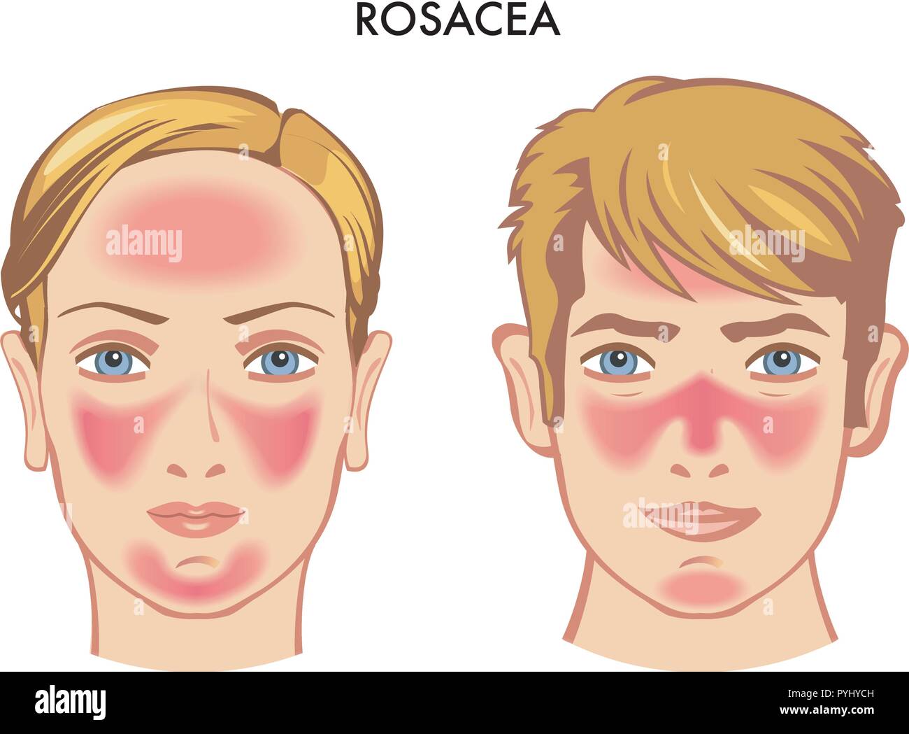 vector medical illustration of the symptoms of rosacea Stock Vector