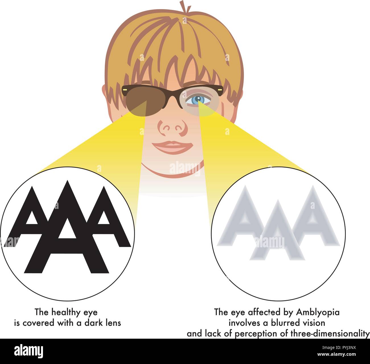 A medical vector illustration of the symptoms of amblyopia Stock Vector