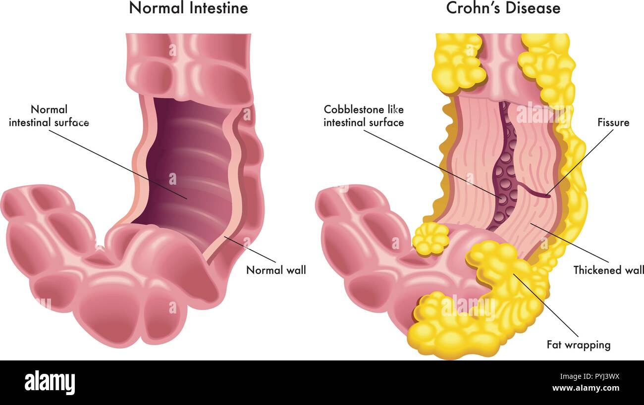 A vector medical illustration of a section of a normal intestine compared to a section of intestine with the symptoms of the Crohn's disease. Stock Vector