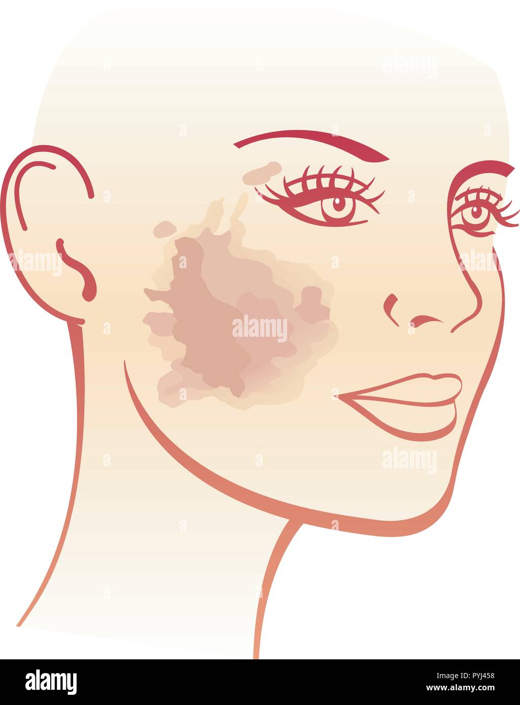 A vector illustration of a woman with a melasma on the cheek. Stock Vector