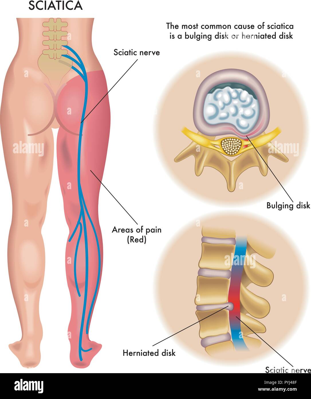 medical illustration of symptoms of sciatica Stock Vector