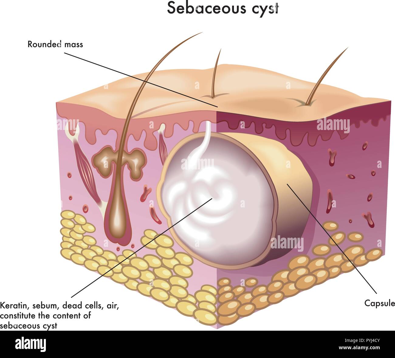 medical illustration of the sebaceous cyst Stock Vector