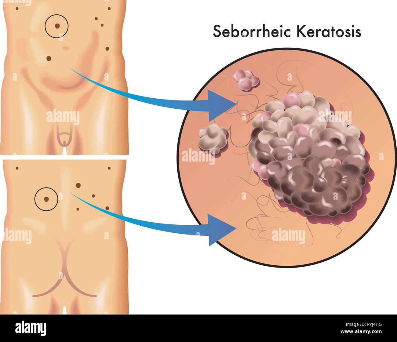 medical illustration of the symptoms of seborrheic keratosis Stock Vector