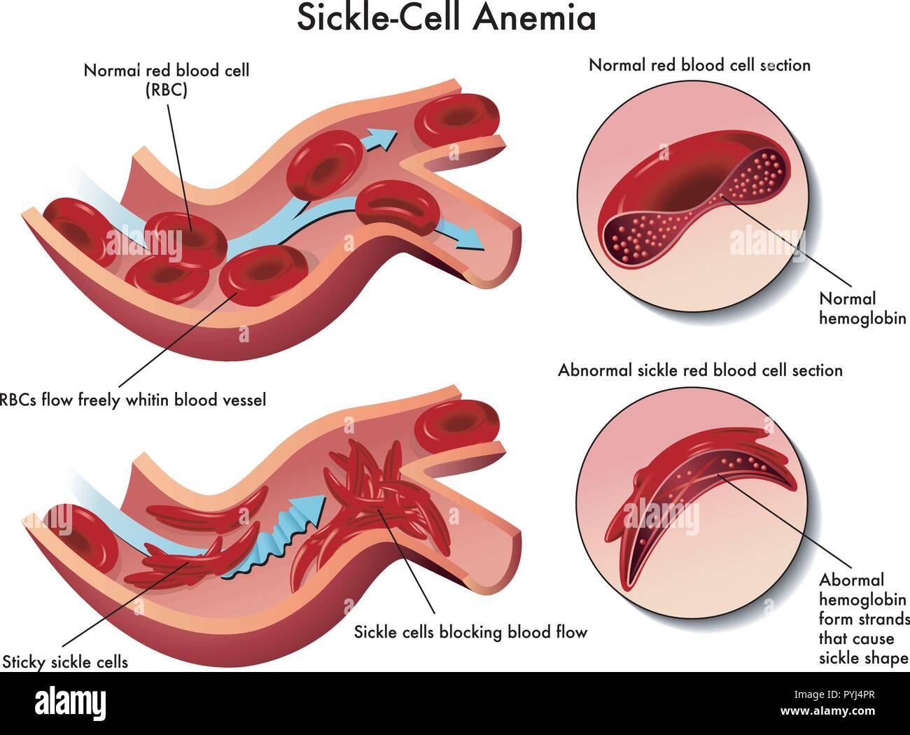 medical illustration of the effects of sickle cell anemia Stock Vector