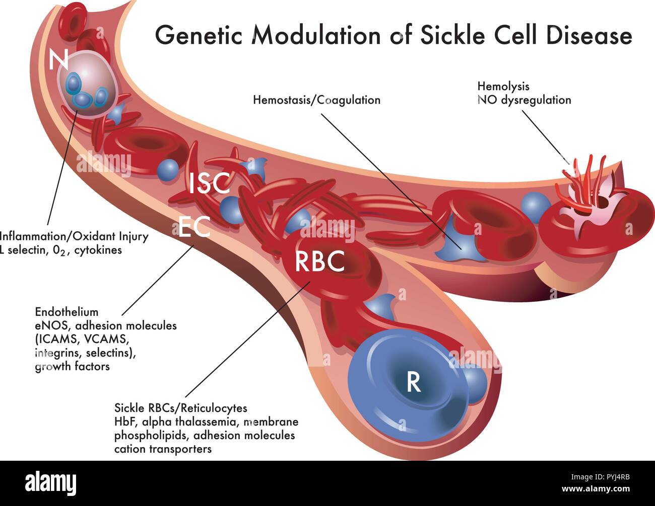 medical illustration of the genetic modulation of sickle cell disease Stock Vector