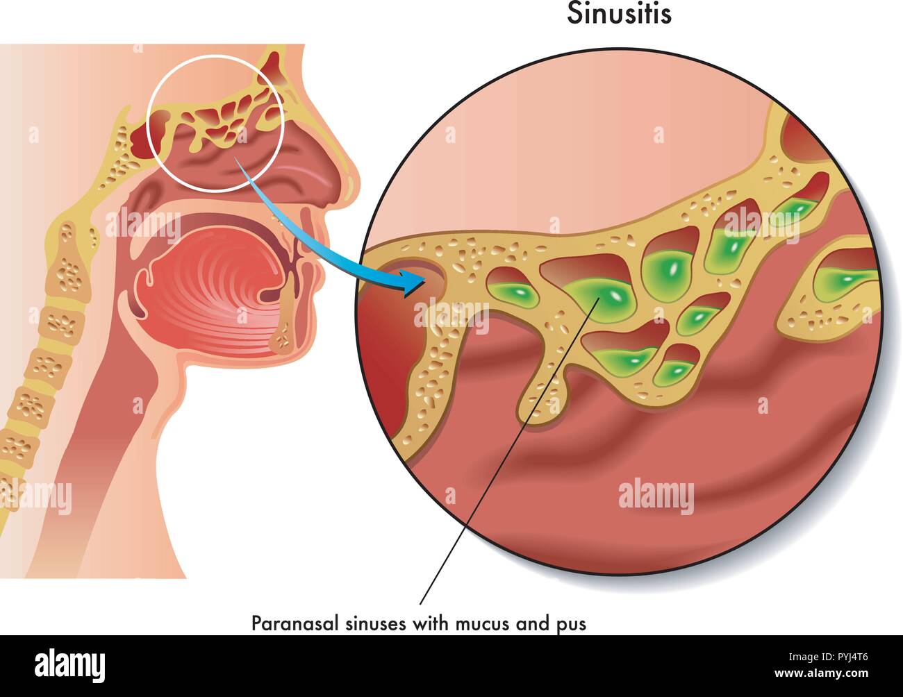 medical illustration of the effects of sinusitis Stock Vector