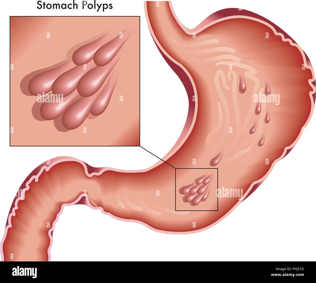 Illustrated medical drawing of stomach with polyps Stock Vector