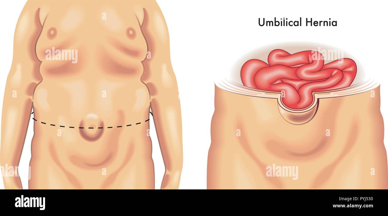 medical illustration of the consequences of umbilical hernia Stock Vector