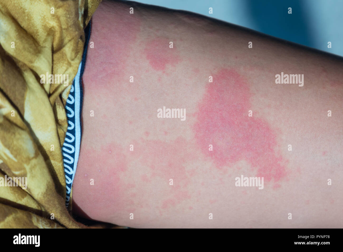 Rash Leg Stock Photos & Rash Leg Stock Images Alamy