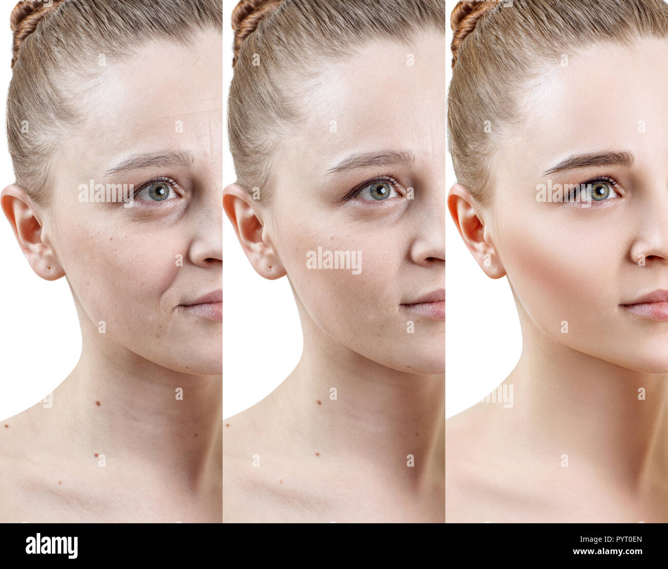 Woman with phase of skin rejuvenation before and after treatment. Stock Photo