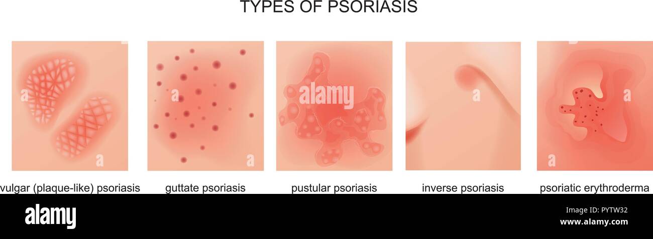 vector illustration of the types of psoriasis  Stock Vector