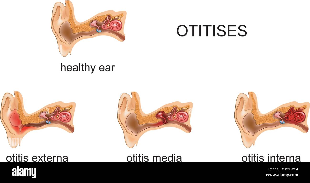vector illustration of otitis media, internal, external Stock Vector