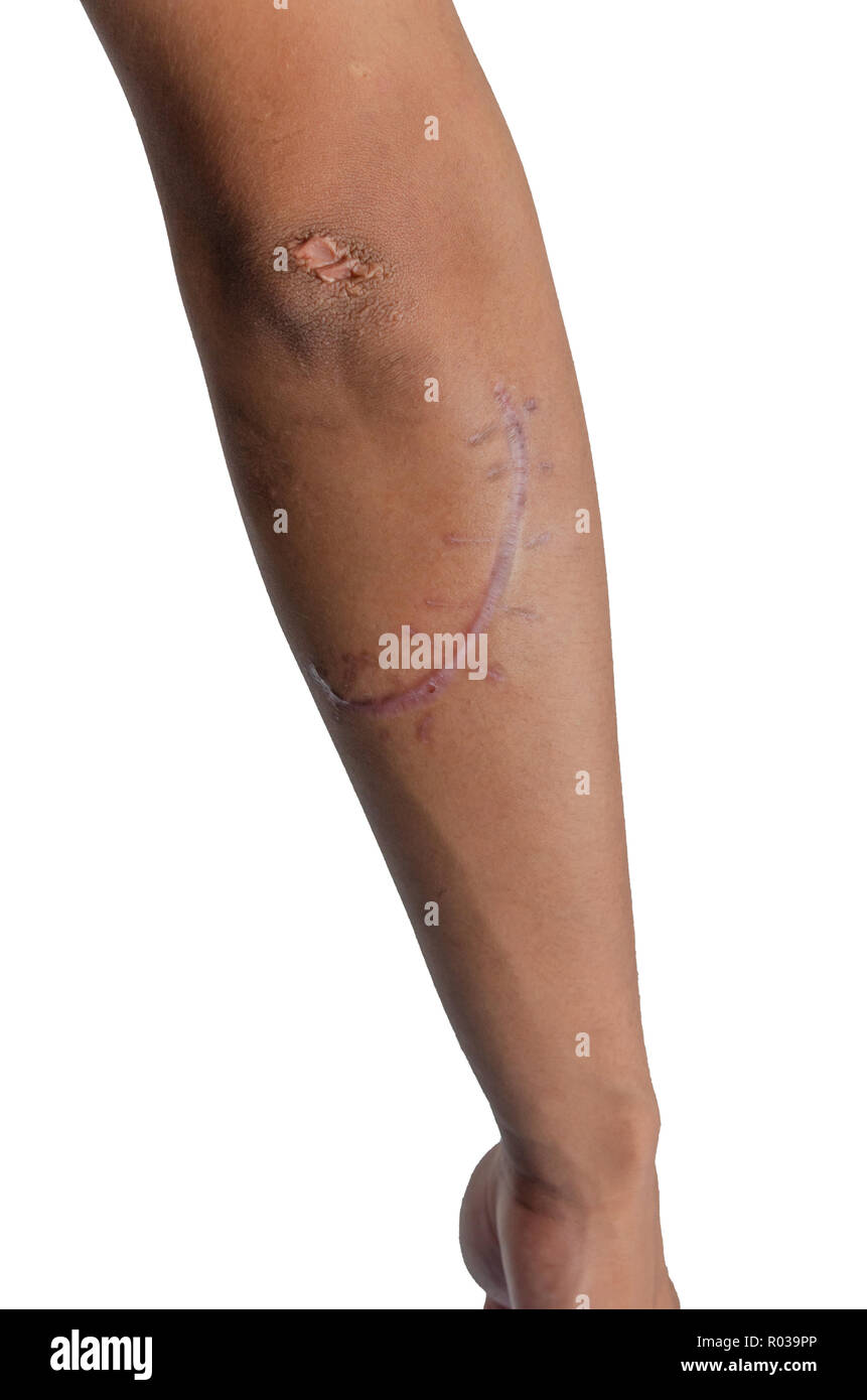 Elbow incision hires stock photography and images Alamy