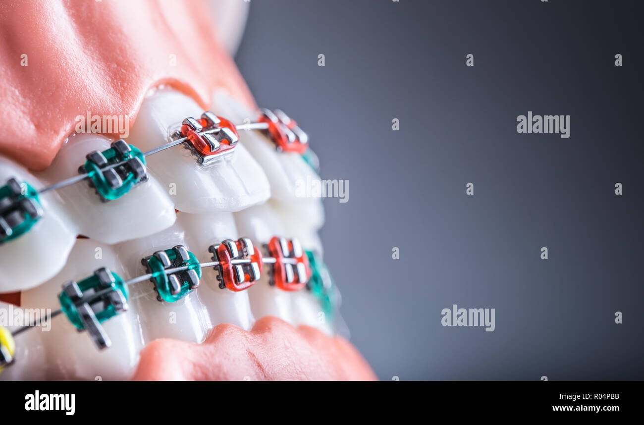 Closeup of a orthodontic model jaws and teeth with braces Stock Photo