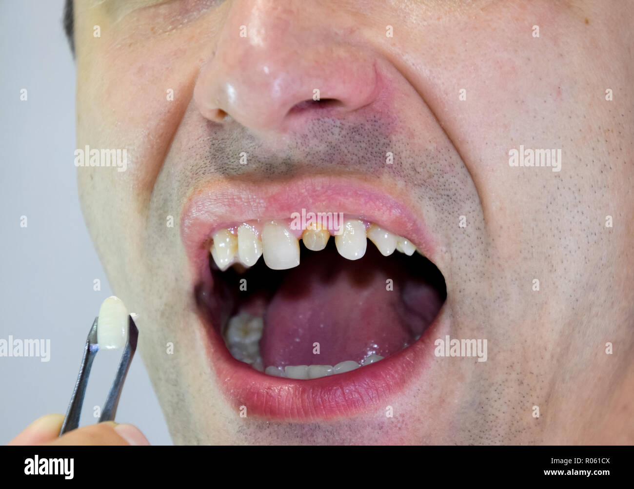 Prosthesis Tooth  . 1,411 Likes · 2 Talking About This · 2 Were Here.