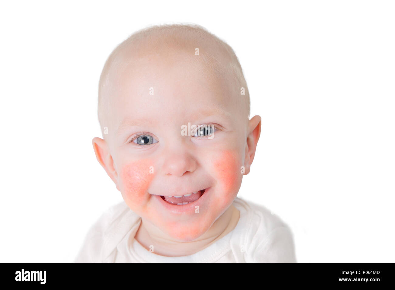 Food allergy concept baby with dermatitis on cheeks, isolated on