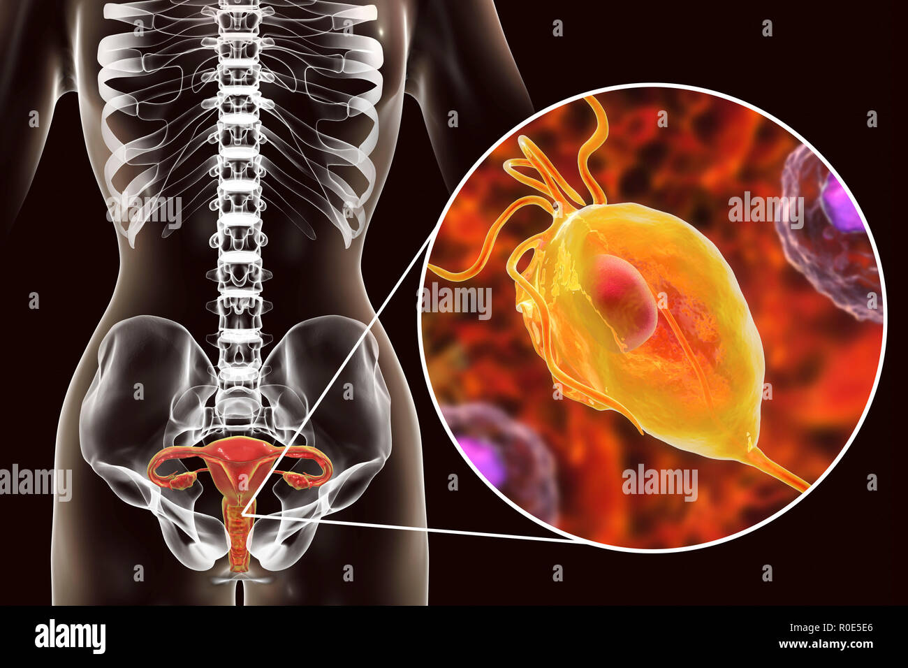 Trichomoniasis, illustration. Computer illustration of the female reproductive system and the parasitic microorganism Trichomonas vaginalis, which is the causative agent of trichomoniasis. Trichomoniasis is a common cause of vaginitis and is a sexually transmitted disease. Stock Photo