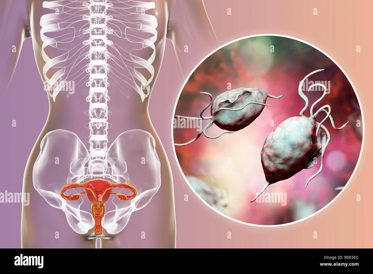 Trichomoniasis, illustration. Computer illustration of the female reproductive system and the parasitic microorganism Trichomonas vaginalis, which is the causative agent of trichomoniasis. Trichomoniasis is a common cause of vaginitis and is a sexually transmitted disease. Stock Photo
