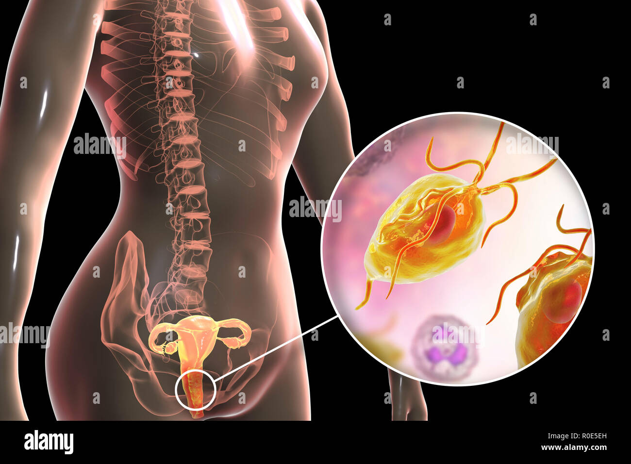 Trichomoniasis, illustration. Computer illustration of the female reproductive system and the parasitic microorganism Trichomonas vaginalis, which is the causative agent of trichomoniasis. Trichomoniasis is a common cause of vaginitis and is a sexually transmitted disease. Stock Photo