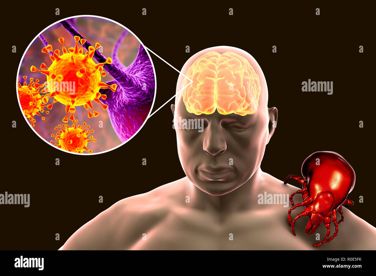 Tick-bourne encephalitis, computer illustration. Tick- borne encephalitis (inflammation of the brain) covers a range of illnesses ranging from a severe paralytic encephalitis, which occurs in Siberia and is transmitted by Ixodes persulcatus, to a less paralytic encephalitis, which is found in central Europe and transmitted by Ixodes ricinus. Agricultural and forestry workers are most frequently affected, as the foci of infection are in and around forest areas, the vertebrate maintenance hosts being rodents and ground-living birds. Stock Photo