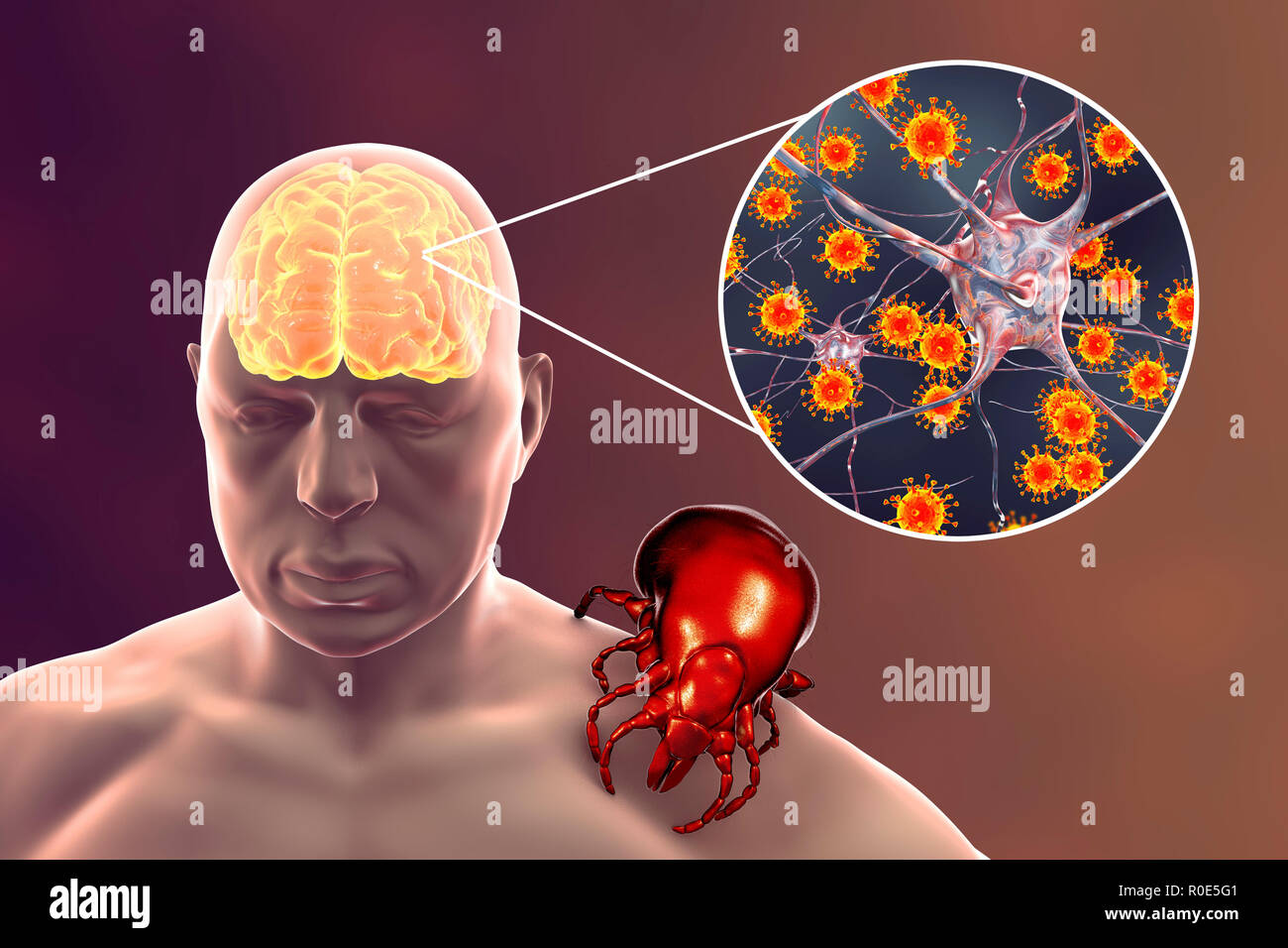 Tick-bourne encephalitis, computer illustration. Tick- borne encephalitis (inflammation of the brain) covers a range of illnesses ranging from a severe paralytic encephalitis, which occurs in Siberia and is transmitted by Ixodes persulcatus, to a less paralytic encephalitis, which is found in central Europe and transmitted by Ixodes ricinus. Agricultural and forestry workers are most frequently affected, as the foci of infection are in and around forest areas, the vertebrate maintenance hosts being rodents and ground-living birds. Stock Photo