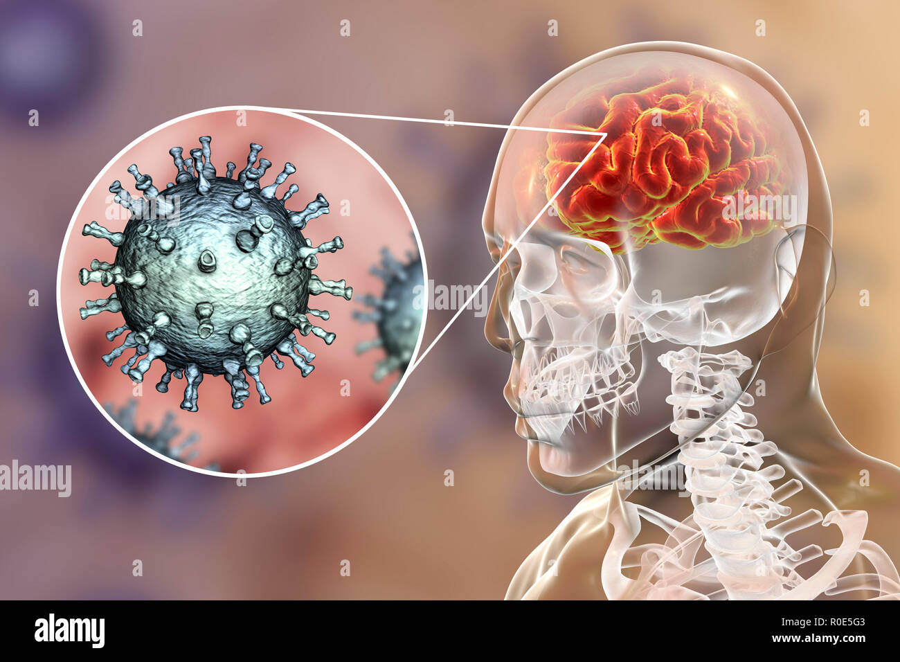 Encephalitis caused by varicella zoster virus (VZV), computer illustration. VZV, a virus from the Herpesviridae family, is the causative agent of chickenpox and shingles. Encephalitis (inflammation of the brain) is one of complications of chickenpox infection. Stock Photo