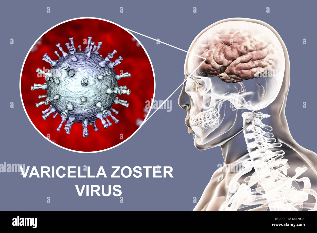 Encephalitis caused by varicella zoster virus (VZV), computer illustration. VZV, a virus from the Herpesviridae family, is the causative agent of chickenpox and shingles. Encephalitis (inflammation of the brain) is one of complications of chickenpox infection. Stock Photo