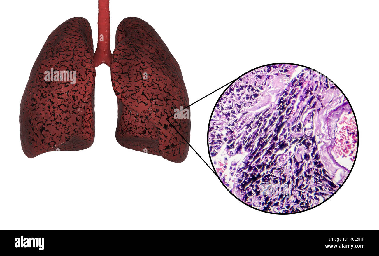 Smoker's lungs, computer illustration and light micrograph Stock Photo