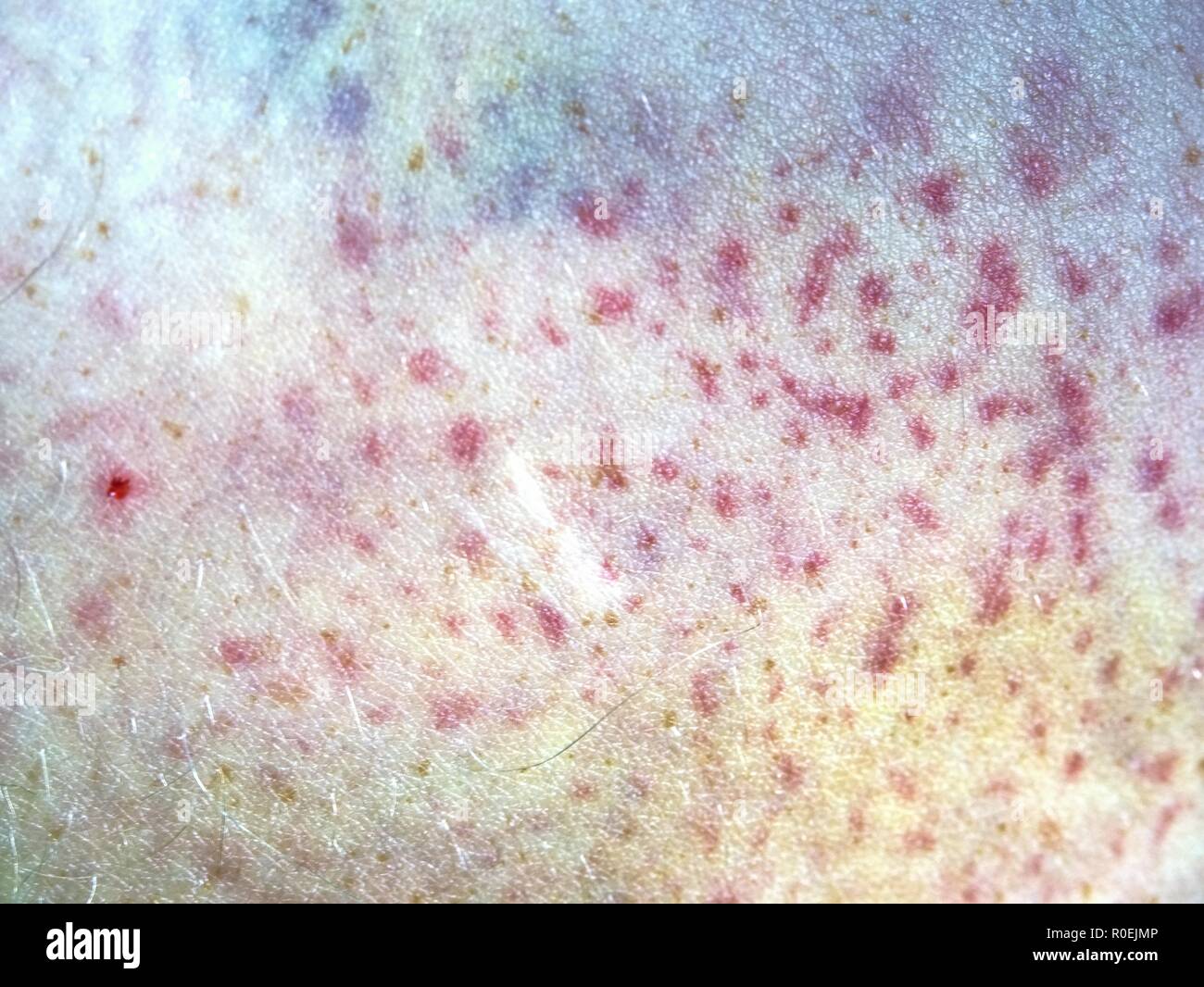 Fresh bruise on white skin.  Painful green purple huge  bruise on male leg.  The subcutaneous injury on human skin Stock Photo