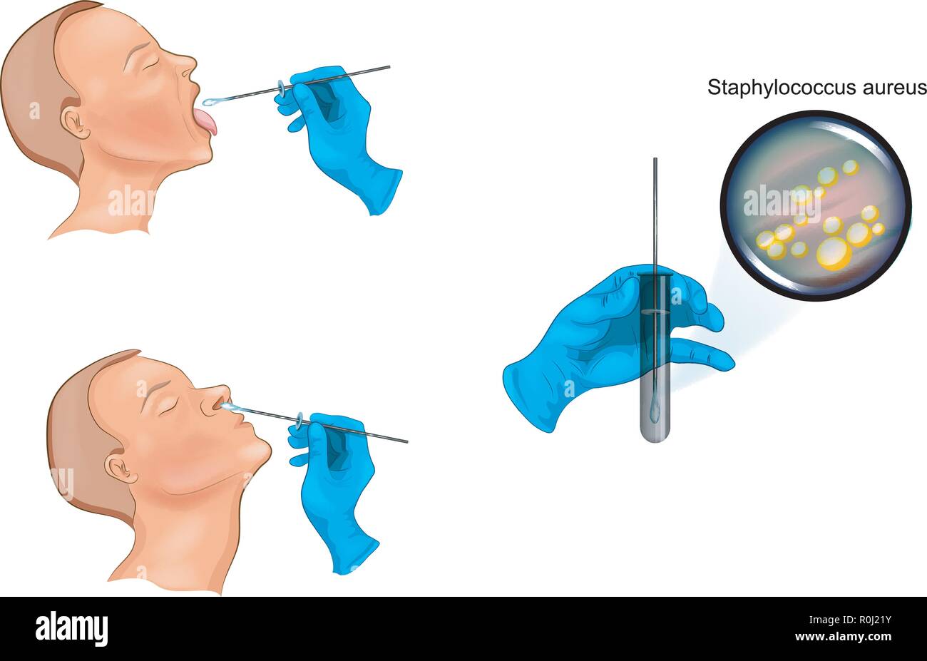vector illustration of a swab from the nose and throat Stock Vector