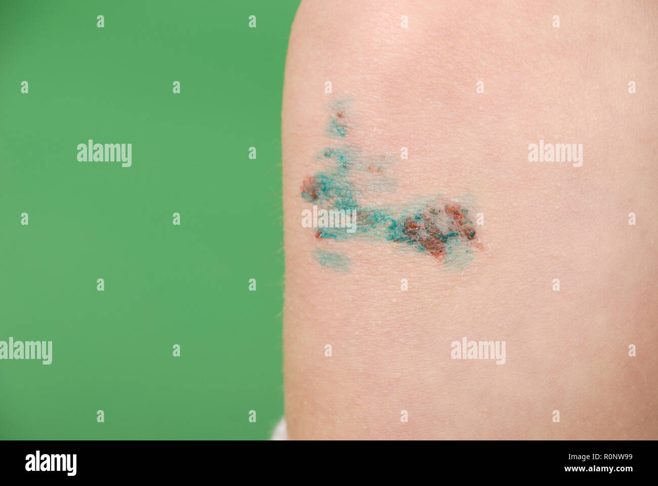 Skin scrape knee child hires stock photography and images Alamy