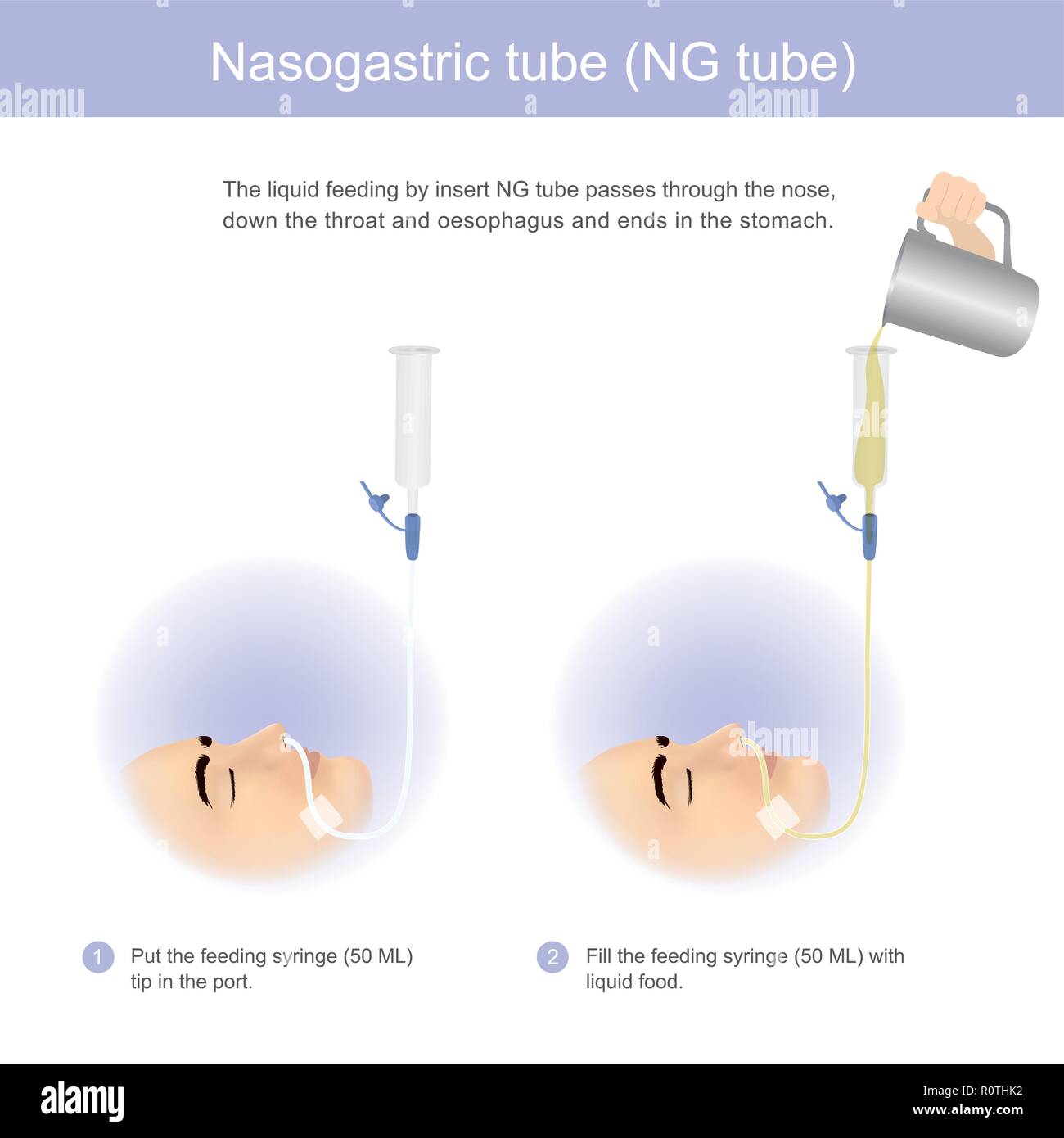The liquid feeding by insert NG tube passes through the nose, down the throat and oesophagus and ends in the stomach. Illustration graphic. Stock Vector