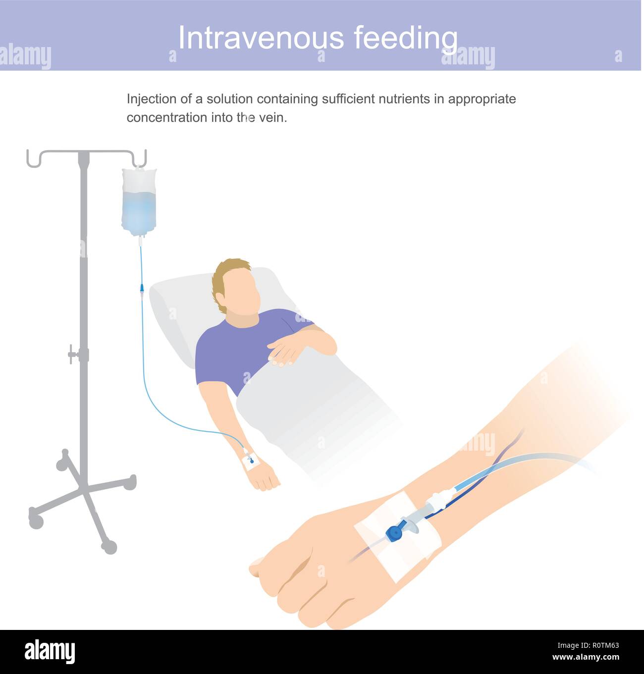 Injection of solution containing sufficient nutrient in appropriate concentration into the vein. Illustration graphic. Stock Vector